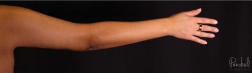 Brachioplasty Before After Photos Case #12306 - Pancholi Cosmetic Surgery