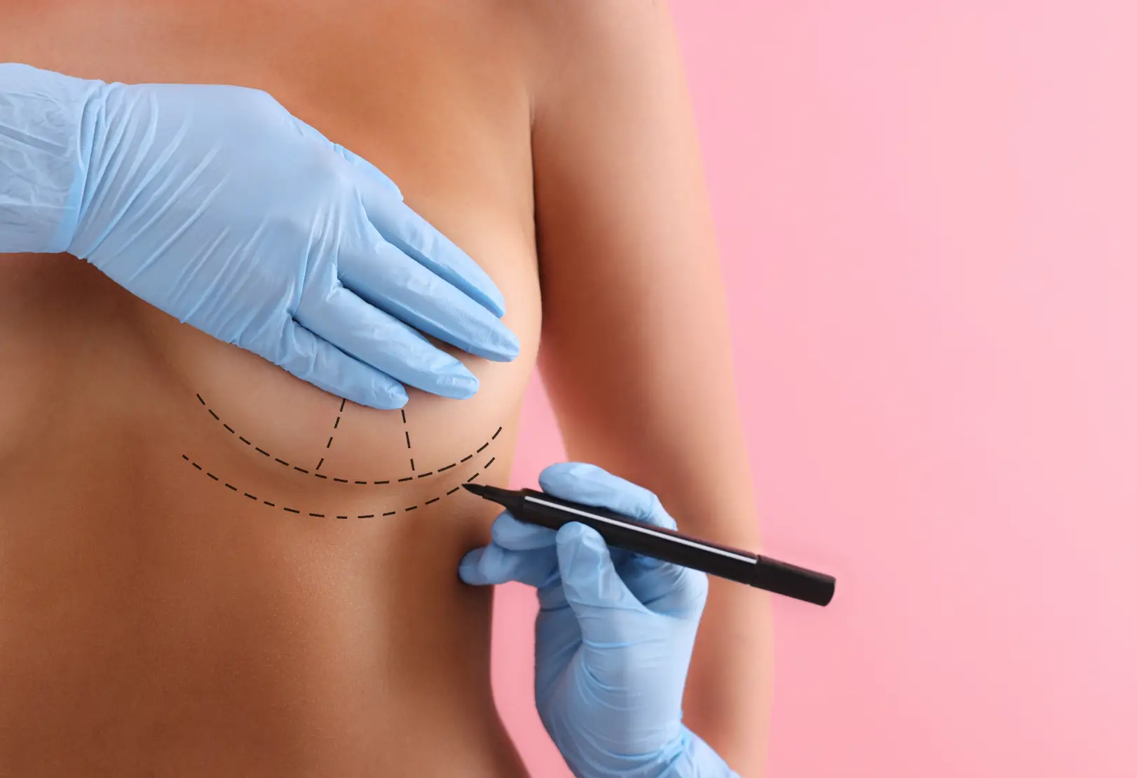 Breast Surgical Markings Close Up Case #12771 - Pancholi Cosmetic Surgery
