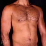 Liposuction Case #12271 - Pancholi Cosmetic Surgery