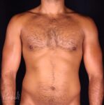 Liposuction Case #12273 - Pancholi Cosmetic Surgery