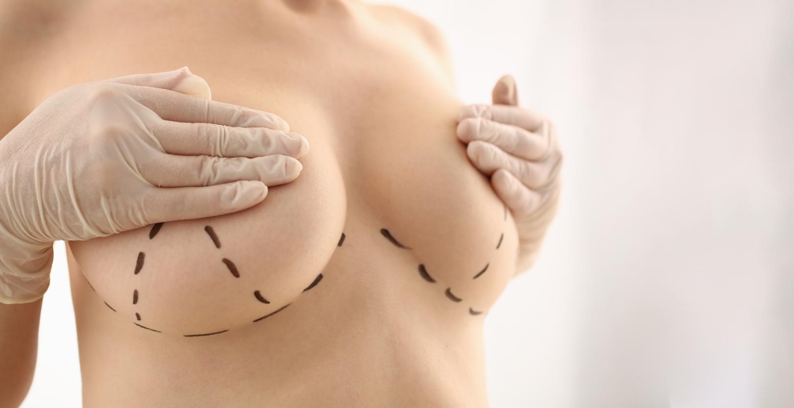 Gloved hands positioned on breasts with dashed surgical markings visible beneath each breast.