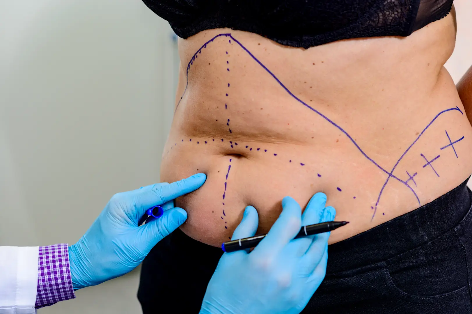 Gloved hands holding a marker near blue surgical markings drawn across a person's abdomen.