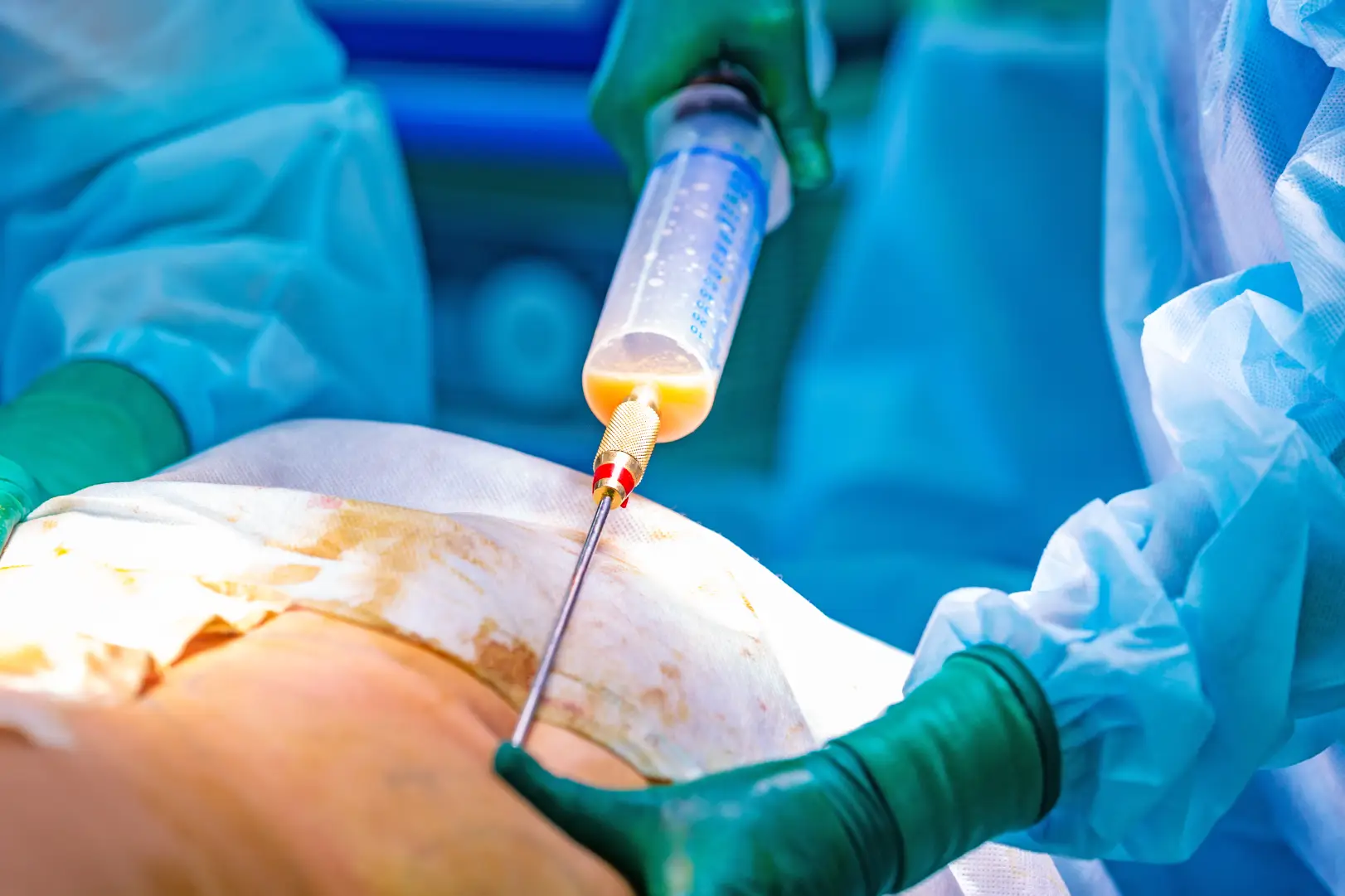 Surgical team uses a cannula connected to a collection syringe during a body procedure.