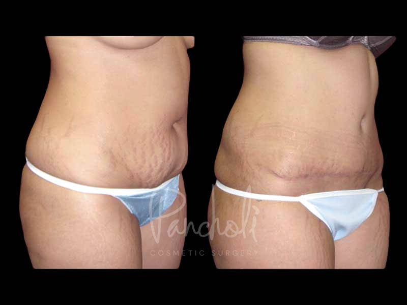 Tummy Tuck Before And After Real Results From Las Vegas Patients Case #13293 - Pancholi Cosmetic Surgery