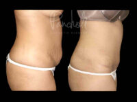 Tummy Tuck Before And After Real Results From Las Vegas Patients Case #13294 - Pancholi Cosmetic Surgery