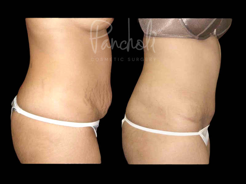 Tummy Tuck Before And After Real Results From Las Vegas Patients Case #13294 - Pancholi Cosmetic Surgery