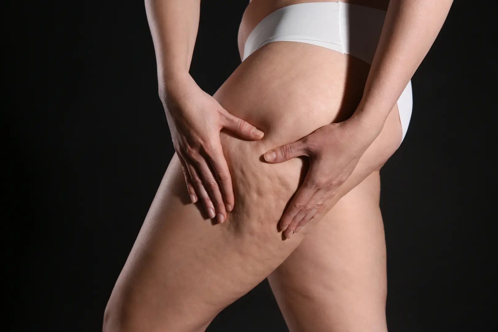 Cellulite Texture On Thigh Case #12742 - Pancholi Cosmetic Surgery