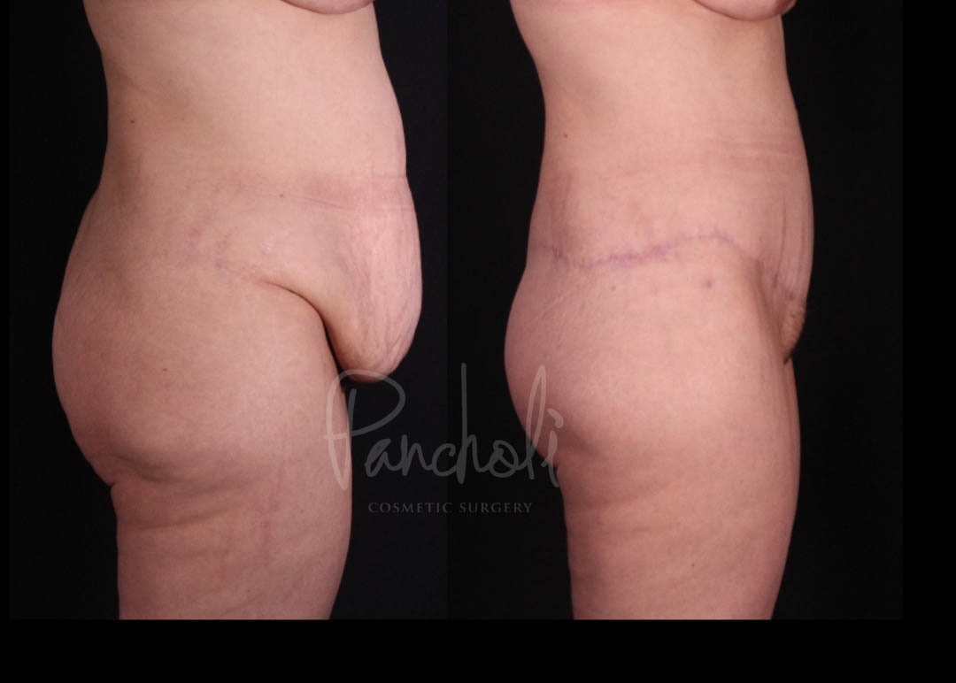 Belt Lipectomy Before After Photos Case #13542 - Pancholi Cosmetic Surgery