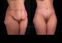 Belt Lipectomy Before After Photos Case #13543 - Pancholi Cosmetic Surgery