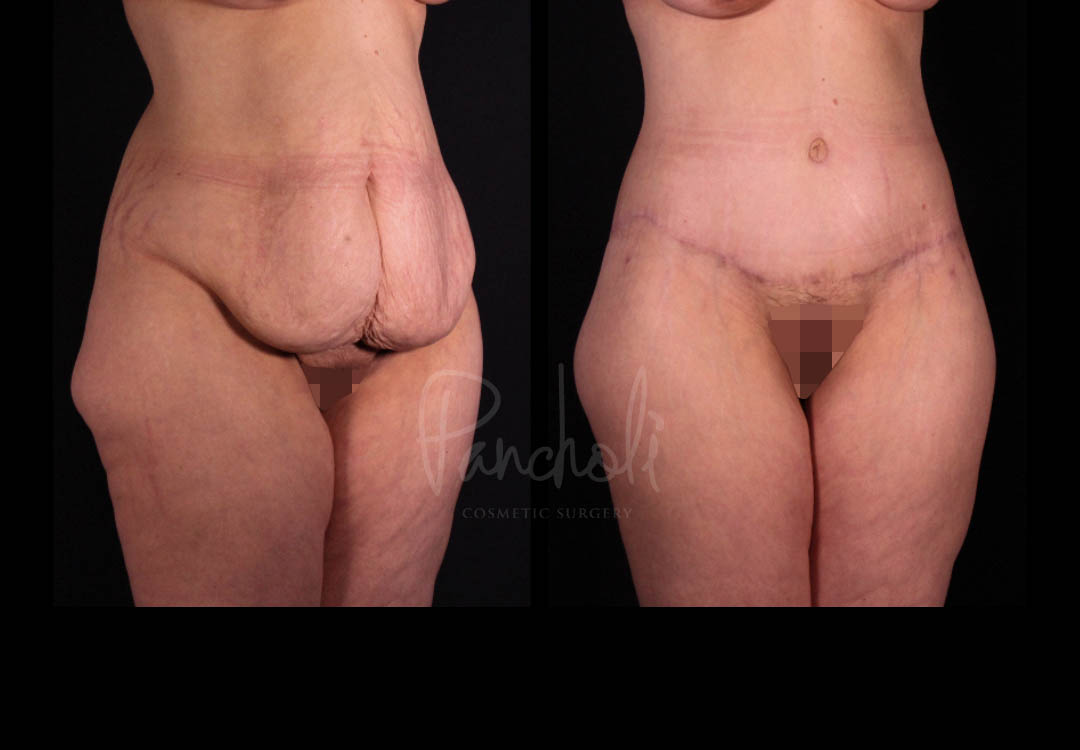 Belt Lipectomy Before After Photos Case #13543 - Pancholi Cosmetic Surgery