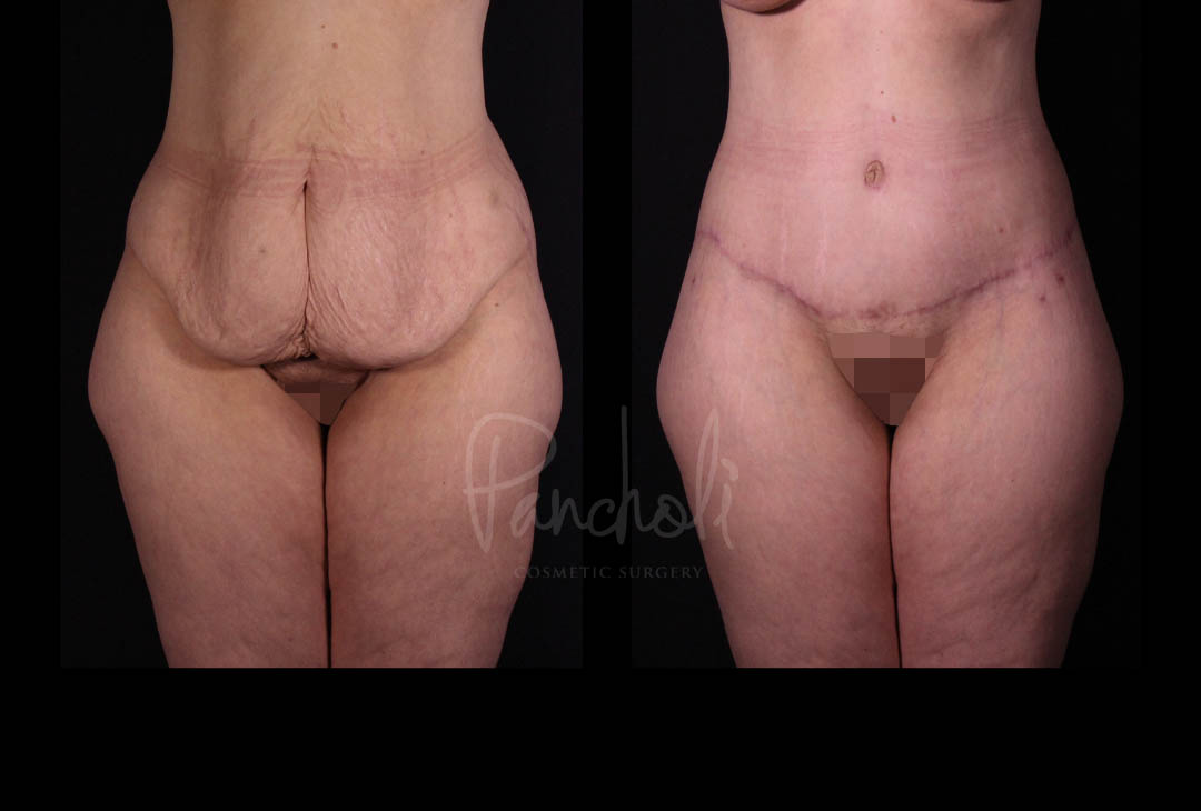 Belt Lipectomy Before After Photos Case #13544 - Pancholi Cosmetic Surgery