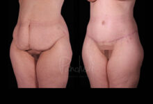 Belt Lipectomy Before After Photos Case #13545 - Pancholi Cosmetic Surgery