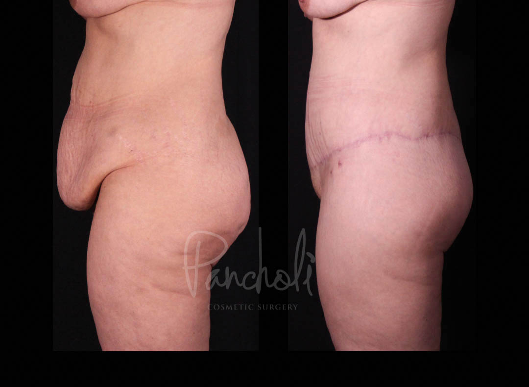 Belt Lipectomy Before After Photos Case #13546 - Pancholi Cosmetic Surgery