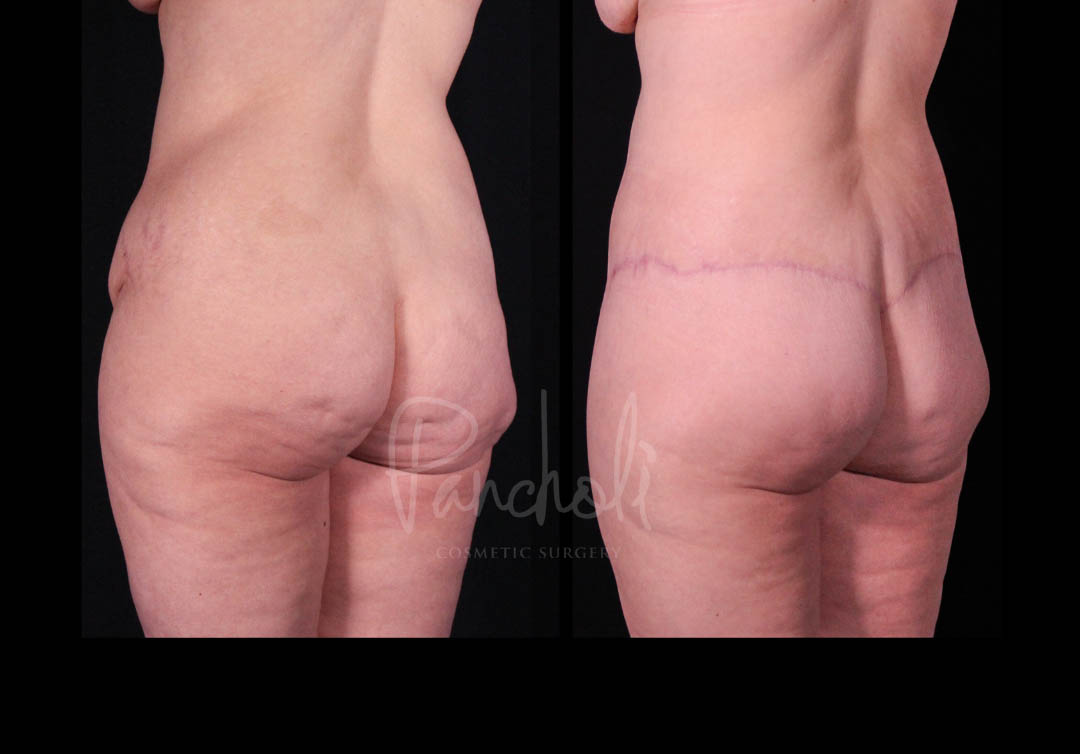 Belt Lipectomy Before After Photos Case #13547 - Pancholi Cosmetic Surgery