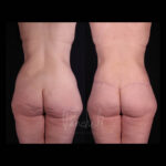 Belt Lipectomy Before After Photos Case #13548 - Pancholi Cosmetic Surgery