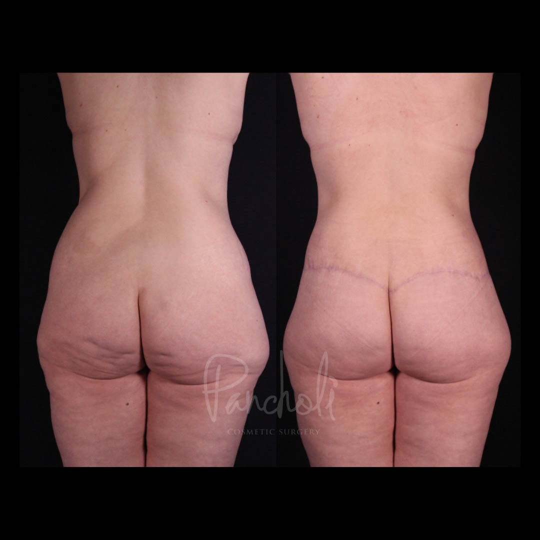 Belt Lipectomy Before After Photos Case #13548 - Pancholi Cosmetic Surgery