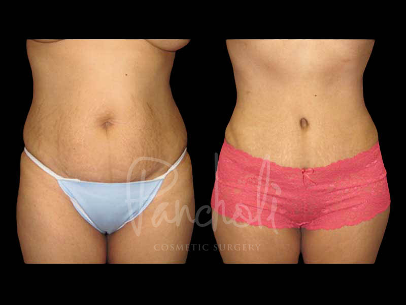 Body Before After Photos Liposuction Before After Photos Tummy Tuck Before And After Real Results From Las Vegas Patients Case #13407 - Pancholi Cosmetic Surgery