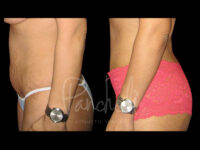 Body Before After Photos Liposuction Before After Photos Tummy Tuck Before And After Real Results From Las Vegas Patients Case #13408 - Pancholi Cosmetic Surgery