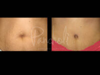 Body Before After Photos Liposuction Before After Photos Tummy Tuck Before And After Real Results From Las Vegas Patients Case #13409 - Pancholi Cosmetic Surgery