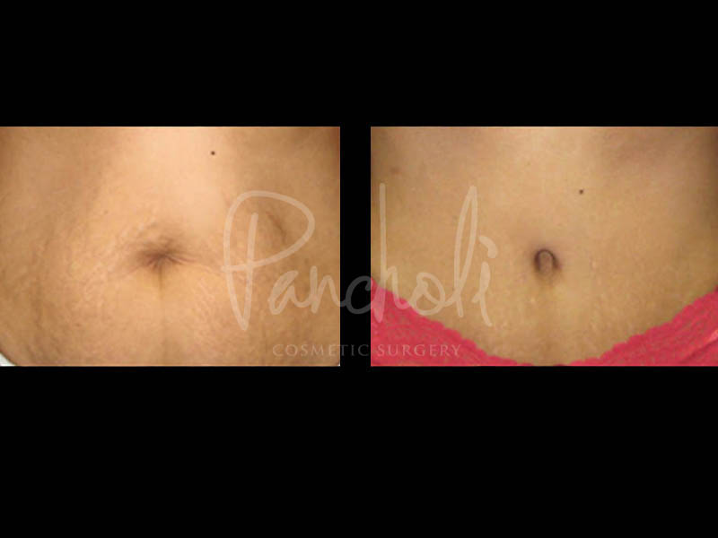 Body Before After Photos Liposuction Before After Photos Tummy Tuck Before And After Real Results From Las Vegas Patients Case #13409 - Pancholi Cosmetic Surgery