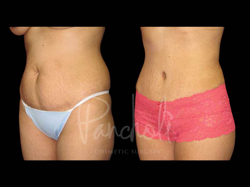 Body Before After Photos Liposuction Before After Photos Tummy Tuck Before And After Real Results From Las Vegas Patients Case #13410 - Pancholi Cosmetic Surgery