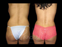 Body Before After Photos Liposuction Before After Photos Tummy Tuck Before And After Real Results From Las Vegas Patients Case #13411 - Pancholi Cosmetic Surgery