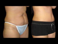 Body Before After Photos Tummy Tuck Before And After Real Results From Las Vegas Patients Case #13372 - Pancholi Cosmetic Surgery