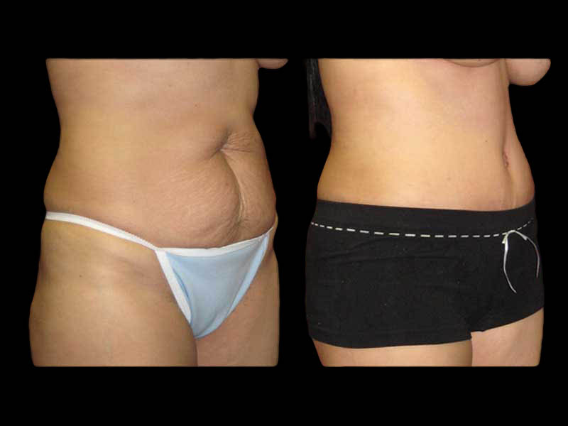 Body Before After Photos Tummy Tuck Before And After Real Results From Las Vegas Patients Case #13372 - Pancholi Cosmetic Surgery