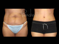 Body Before After Photos Tummy Tuck Before And After Real Results From Las Vegas Patients Case #13373 - Pancholi Cosmetic Surgery