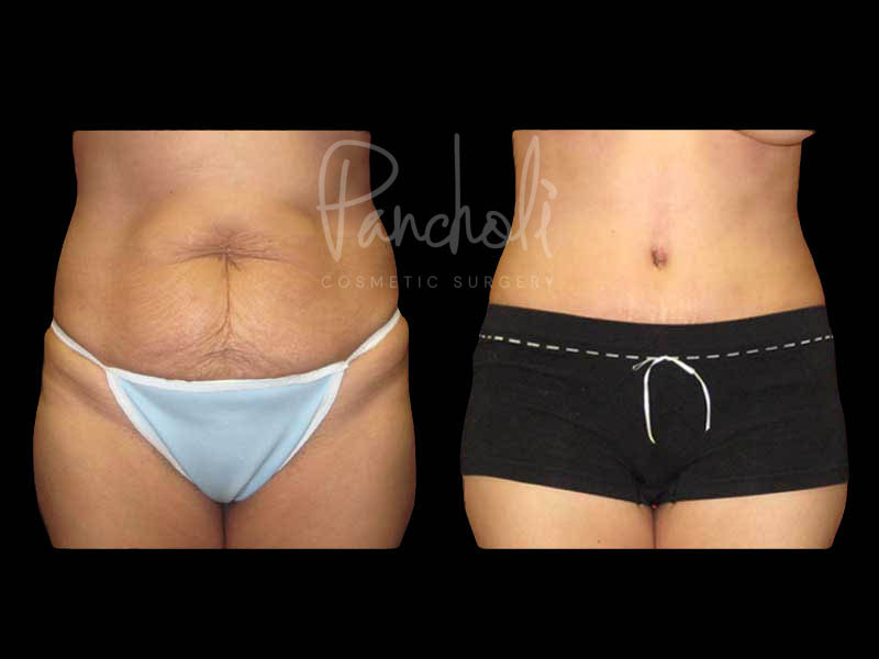 Body Before After Photos Tummy Tuck Before And After Real Results From Las Vegas Patients Case #13373 - Pancholi Cosmetic Surgery
