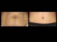 Body Before After Photos Tummy Tuck Before And After Real Results From Las Vegas Patients Case #13374 - Pancholi Cosmetic Surgery