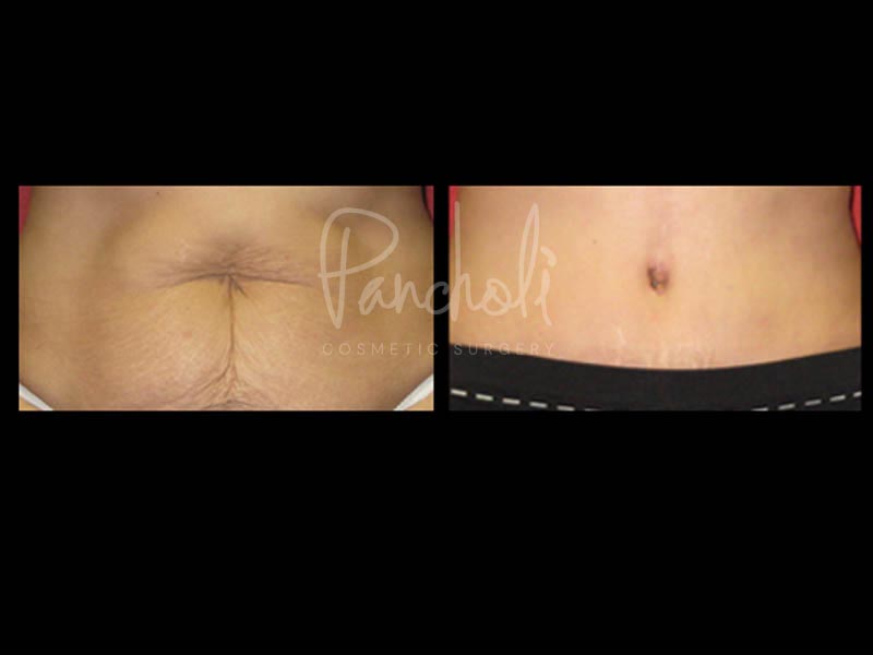 Body Before After Photos Tummy Tuck Before And After Real Results From Las Vegas Patients Case #13374 - Pancholi Cosmetic Surgery