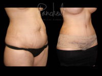 Body Before After Photos Tummy Tuck Before And After Real Results From Las Vegas Patients Case #13380 - Pancholi Cosmetic Surgery
