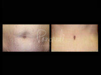 Body Before After Photos Tummy Tuck Before And After Real Results From Las Vegas Patients Case #13381 - Pancholi Cosmetic Surgery