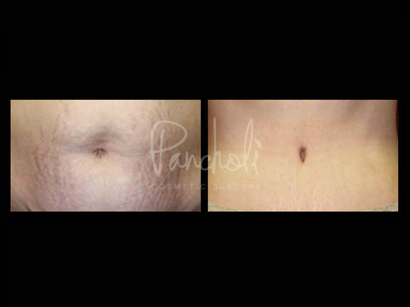 Body Before After Photos Tummy Tuck Before And After Real Results From Las Vegas Patients Case #13381 - Pancholi Cosmetic Surgery