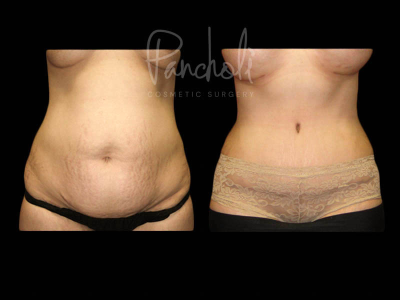 Body Before After Photos Tummy Tuck Before And After Real Results From Las Vegas Patients Case #13382 - Pancholi Cosmetic Surgery