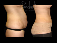 Body Before After Photos Tummy Tuck Before And After Real Results From Las Vegas Patients Case #13383 - Pancholi Cosmetic Surgery