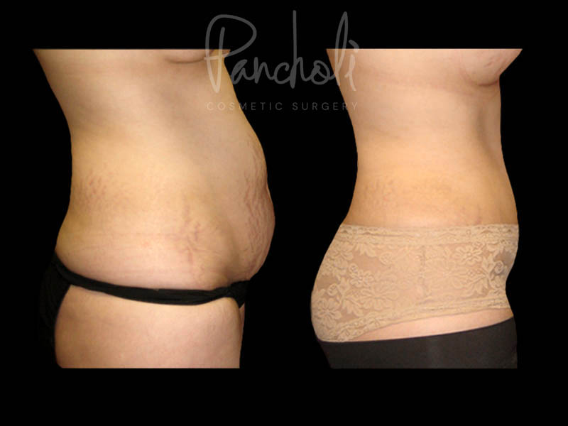 Body Before After Photos Tummy Tuck Before And After Real Results From Las Vegas Patients Case #13383 - Pancholi Cosmetic Surgery