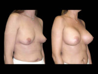 Breast Augmentation Before After Photos Case #13463 - Pancholi Cosmetic Surgery
