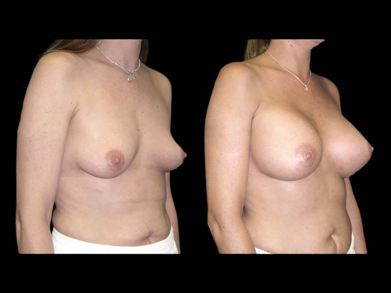 Breast Augmentation Before After Photos Case #13463 - Pancholi Cosmetic Surgery