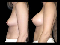 Breast Augmentation Before After Photos Case #13464 - Pancholi Cosmetic Surgery