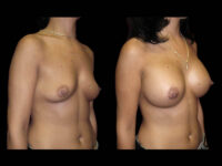 Breast Augmentation Before After Photos Case #13466 - Pancholi Cosmetic Surgery