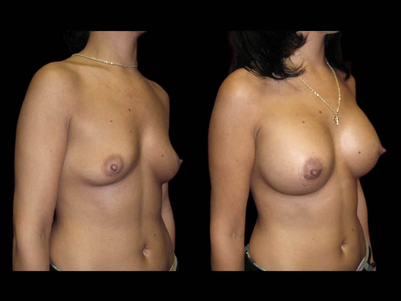 Breast Augmentation Before After Photos Case #13466 - Pancholi Cosmetic Surgery