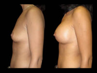 Breast Augmentation Before After Photos Case #13467 - Pancholi Cosmetic Surgery