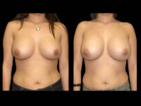 Breast Augmentation Before After Photos Case #13469 - Pancholi Cosmetic Surgery