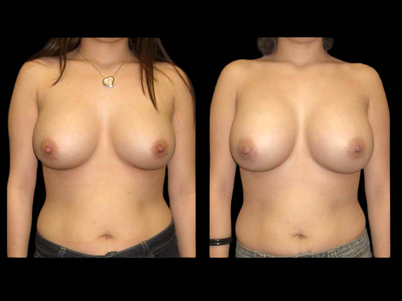 Breast Augmentation Before After Photos Case #13469 - Pancholi Cosmetic Surgery