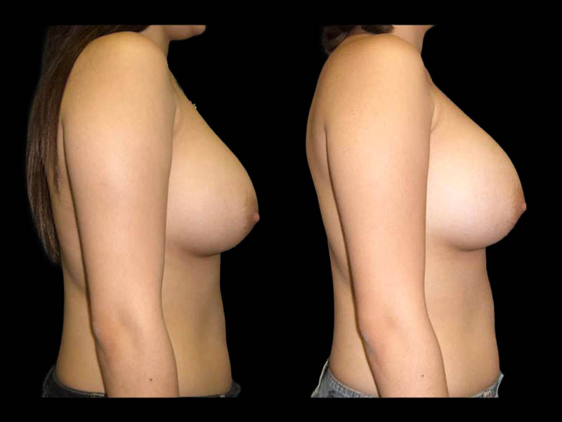 Breast Augmentation Before After Photos Case #13470 - Pancholi Cosmetic Surgery