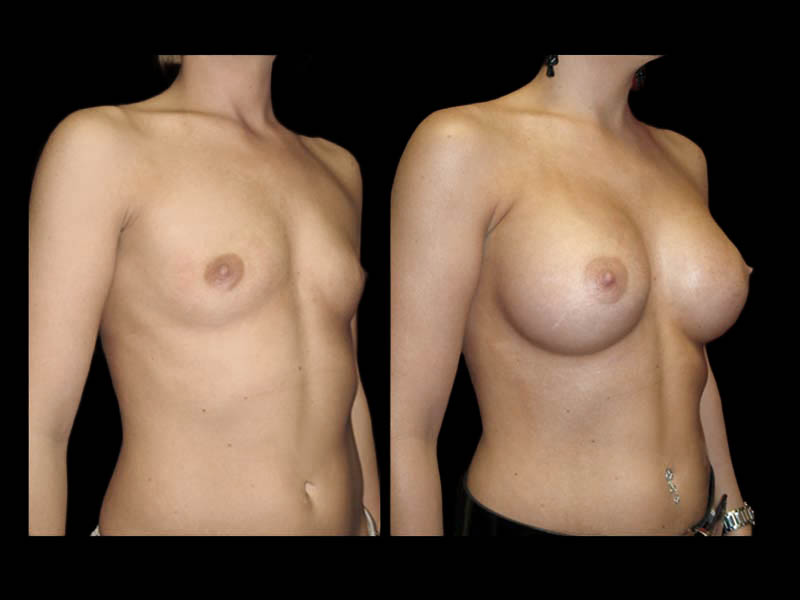 Breast Augmentation Before After Photos Case #13472 - Pancholi Cosmetic Surgery
