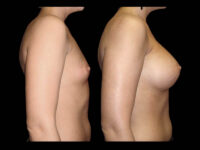 Breast Augmentation Before After Photos Case #13473 - Pancholi Cosmetic Surgery