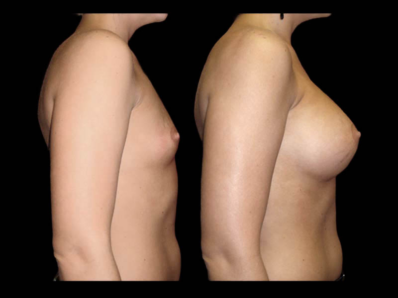Breast Augmentation Before After Photos Case #13473 - Pancholi Cosmetic Surgery